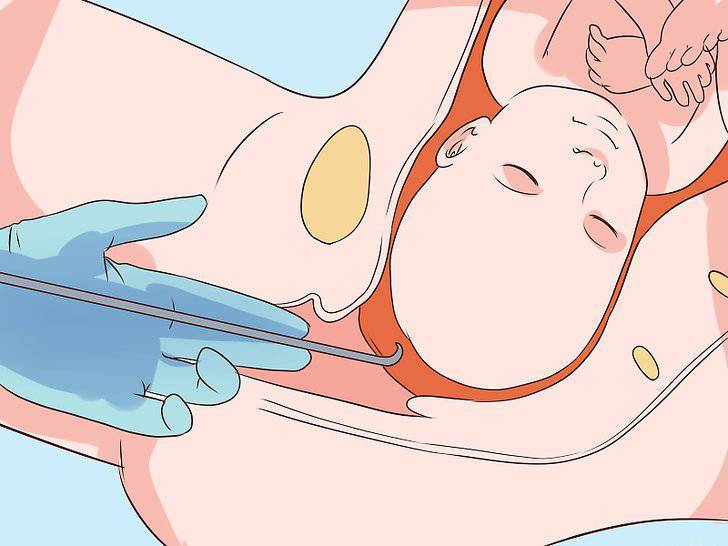 Как родить без разрывов и быстро: Как избежать разрывов во время родов?