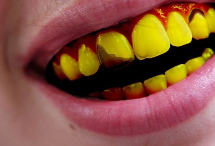 Желтые зубы причины: причины, что делать – стоматология Президент