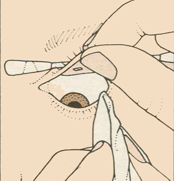 Как вытащить инородное тело из глаза: Инородное тело в глазу. Помощь при попадании и удаление инородного тела из глаза