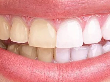 Желтые зубы причины: причины, что делать – стоматология Президент