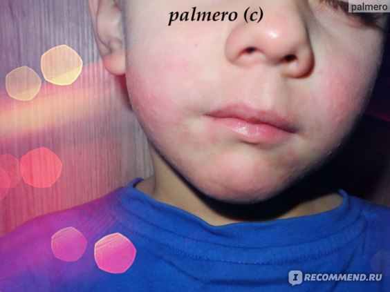 Аллергия на кешью симптомы: аллерген или нет, симптомы, противопоказания