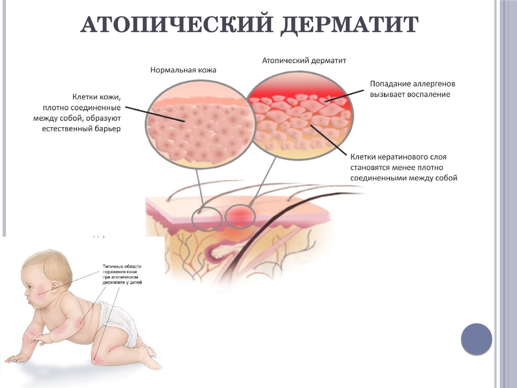 Лечение атопического дерматита у детей по методу доктора Комаровского: эффективные способы и рекомендации