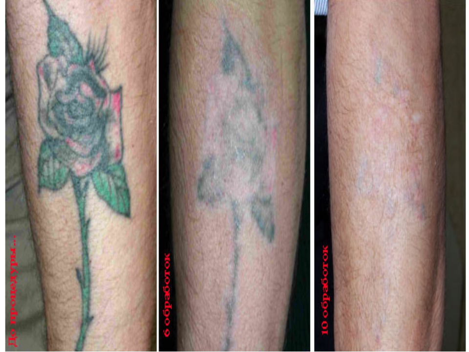 Краска выходит из татуировки: Отваливается пигмент - что делать и как избежать выхода краски из тату
