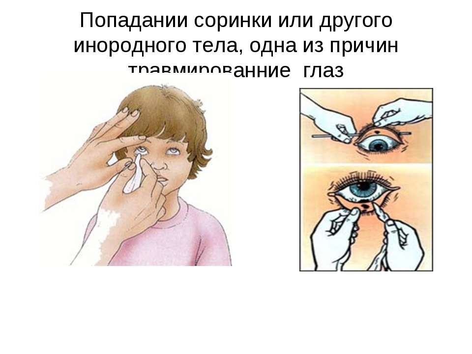 Как достать из глаза инородное тело в домашних условиях: Что-то попало в глаз и не выходит: порядок действий, обзор методов, отзывы