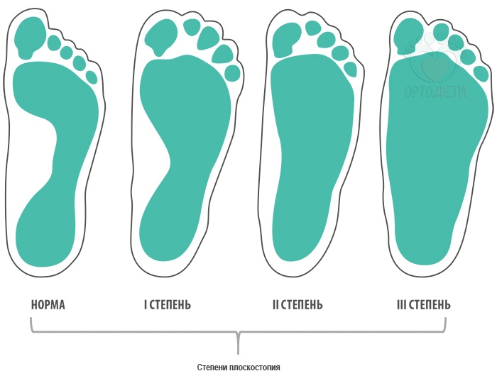 Плоскостопия у детей степени: Плоскостопие у детей – лучшие способы диагностики и лечения